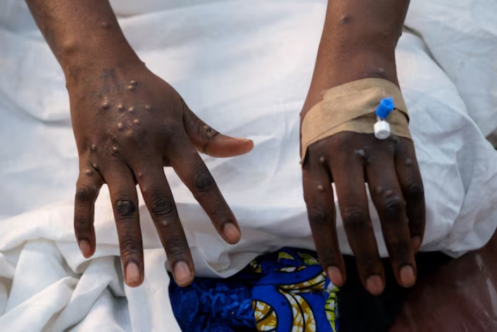 Las manos de un paciente con erupciones cutáneas causadas por el virus mpox