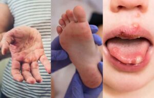 fiebre aftosa 1